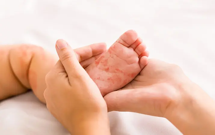 Заболевания кожи у новорожденных