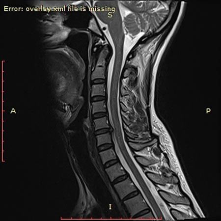 mify osteohondroz 13.04 ris 3