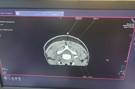mify osteohondroz 13.04 ris 5