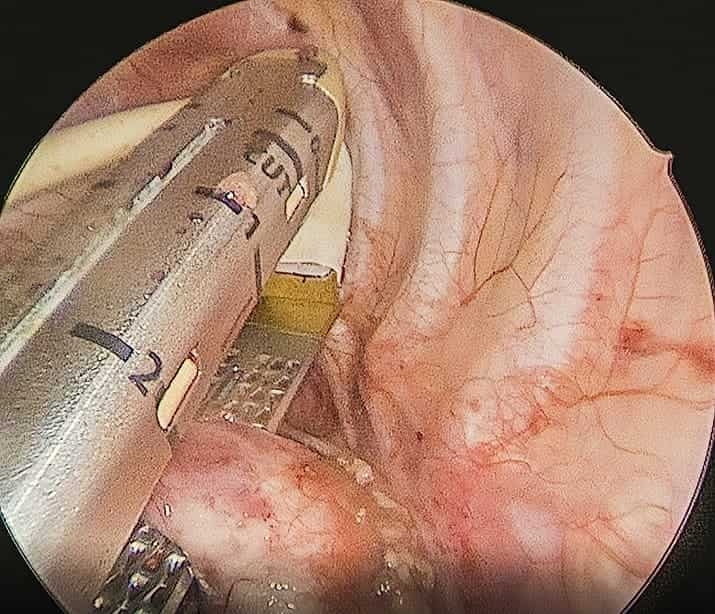 Dvojnaya duga aorty operaciya2 1