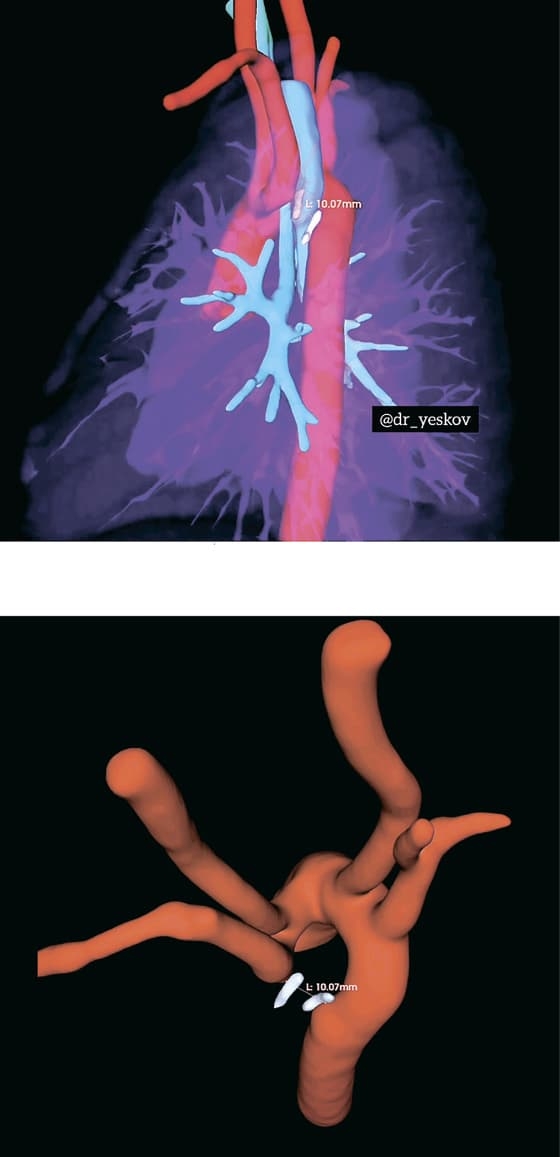 Dvojnaya duga aorty operaciya5 1