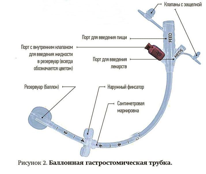 Gastrostomicheskaya trubka 2