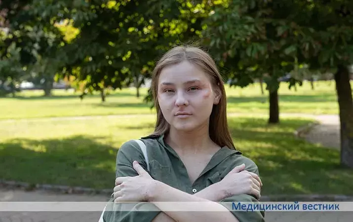 Алина Акименко: «Я знала, что ужасно выгляжу, но то, что я чувствовала, было страшнее»