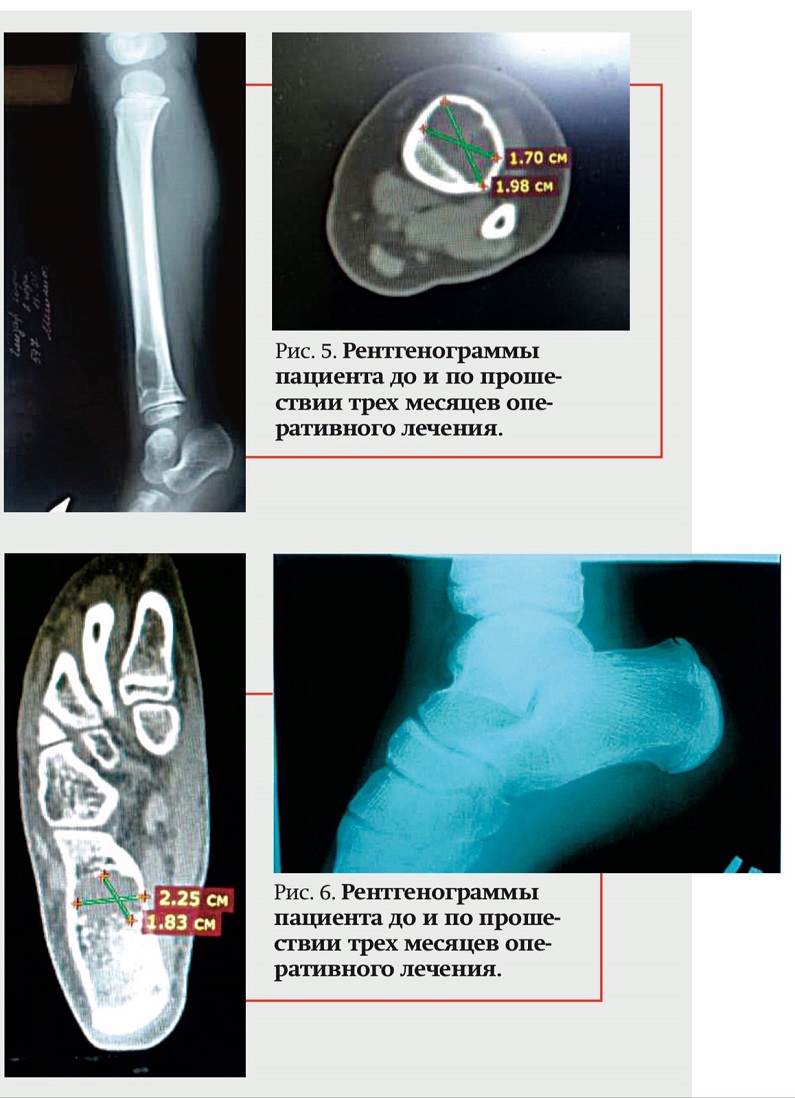 rentgenogrammyi do i posle operecii